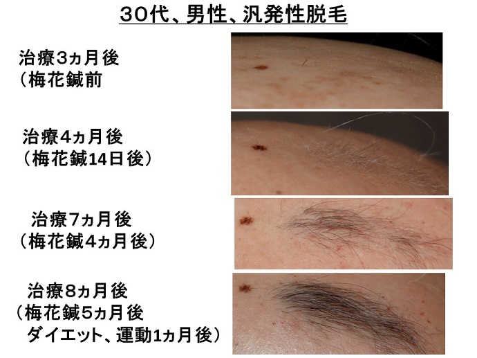 円形脱毛症　病院